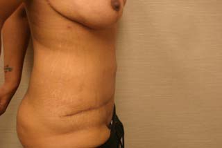 bariatric 5